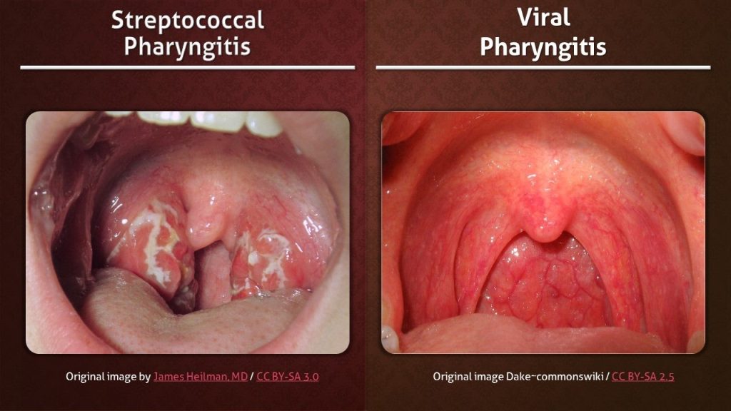 Dhimbje fyti: Virus apo infeksion bakterial?